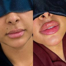 Russian Lip Filler in Dubai